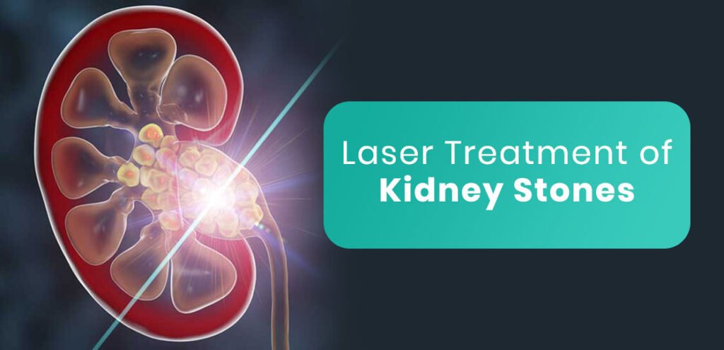 remove kidney stone by laser, kidney stone,