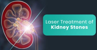 remove kidney stone by laser, kidney stone,