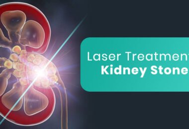 remove kidney stone by laser, kidney stone,