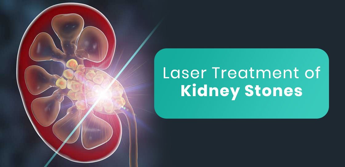 How to get rid of kidney stones with laser operation Kadva Corp